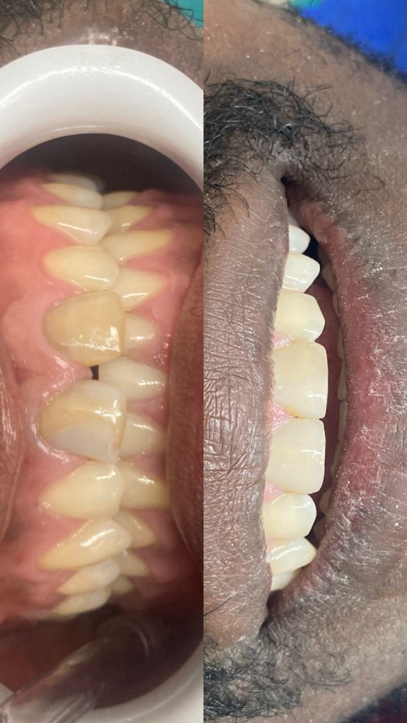 Antes y después - Perfil lateral