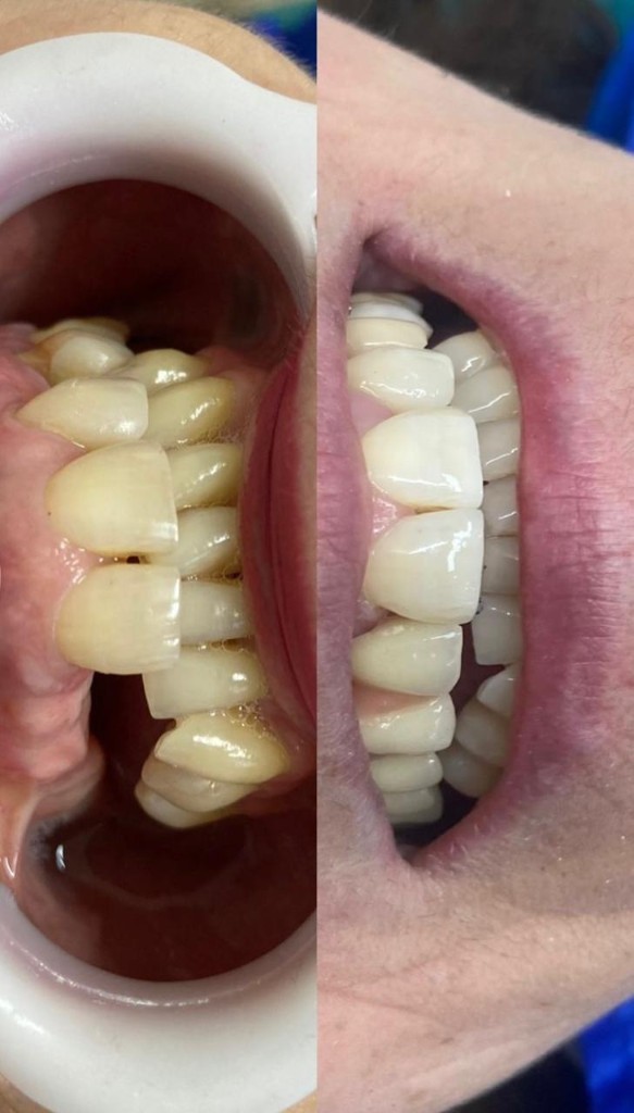 Antes y después - Perfil molar