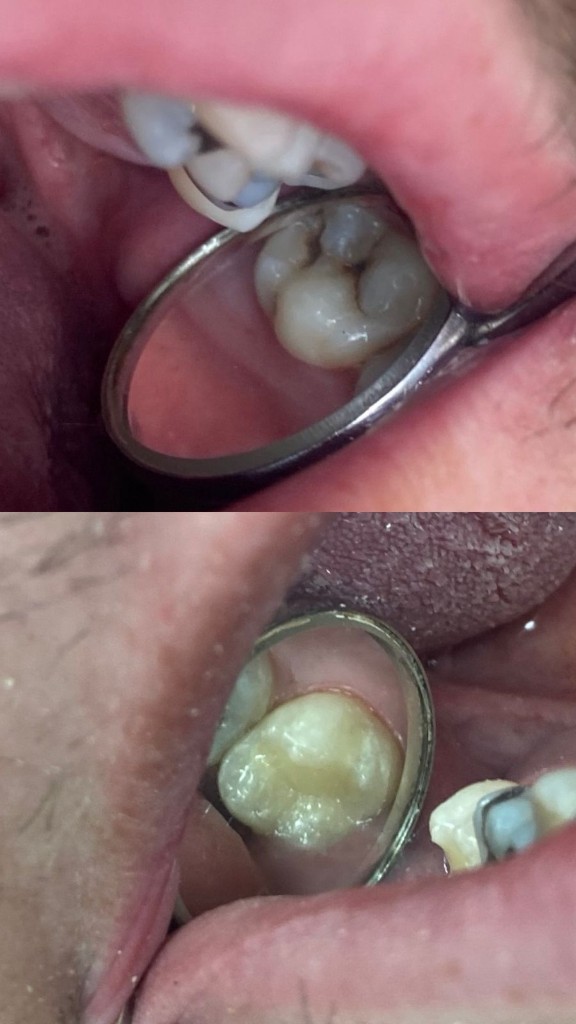 Antes y después - Restauración molar