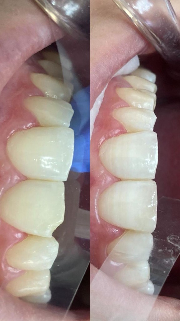 Antes y después - Restauraciones