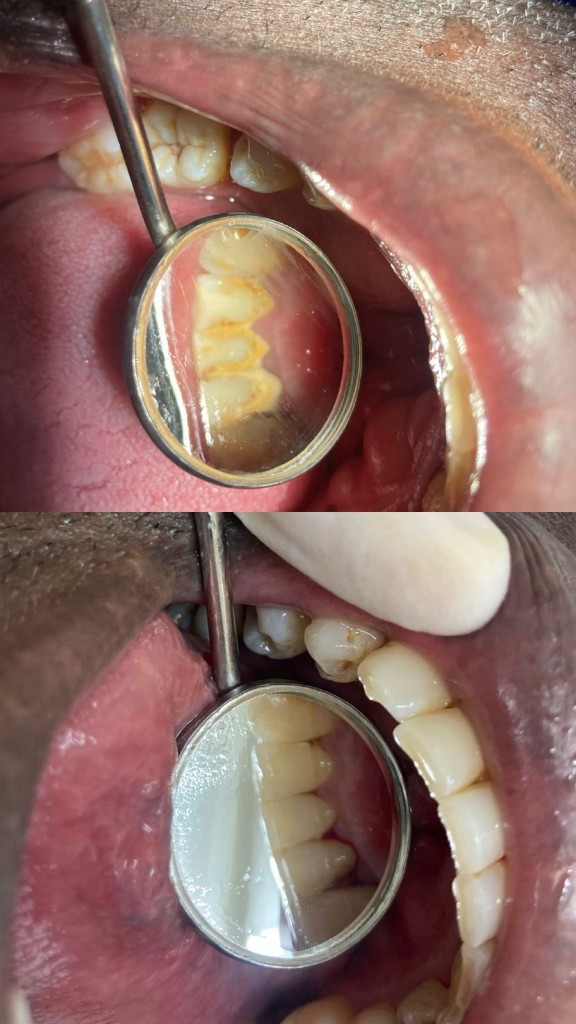 Antes y después - Limpieza dental